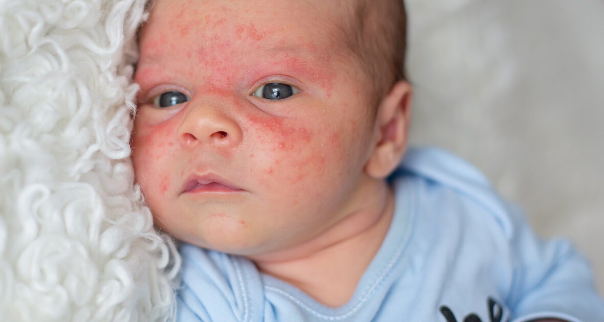 Причины дерматита у грудного ребенка: