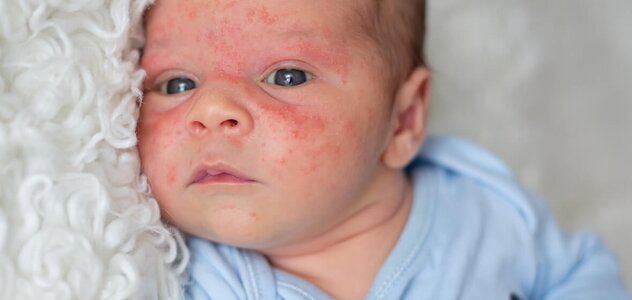 The baby lies on a white, shaggy blanket, looking straight into the camera. The blue-eyed baby has a rash on his face. The child clenches his fists and seems to feel discomfort.