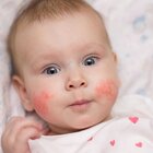  The infant lies in a cot. The child has a red rash on his cheeks. The baby looks straight ahead. The baby is wearing a white blouse with hearts.