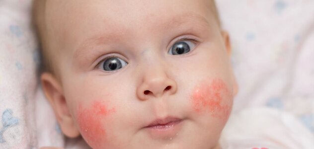  The infant lies in a cot. The child has a red rash on his cheeks. The baby looks straight ahead. The baby is wearing a white blouse with hearts.